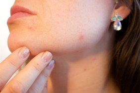 Sivilceli Ciltlerin Yaptığı Makyaj Hataları