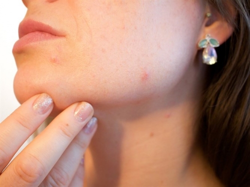 Sivilceli Ciltlerin Yaptığı Makyaj Hataları