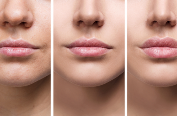 Lip Lift ile Hayallerinizdeki Dudaklara Kavuşun