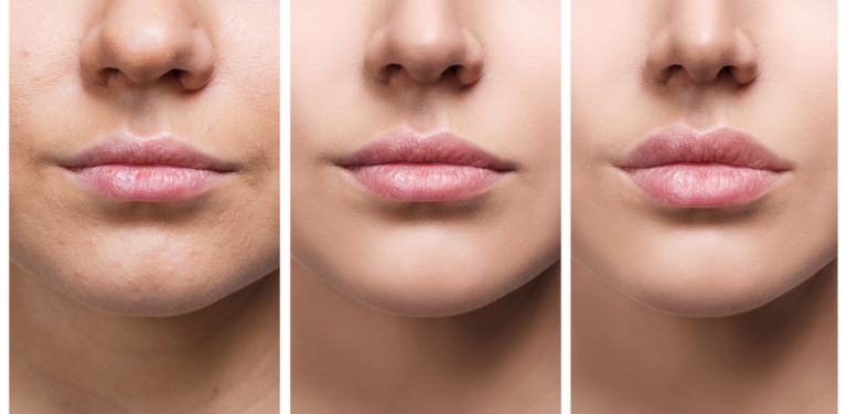 Lip Lift ile Hayallerinizdeki Dudaklara Kavuşun
