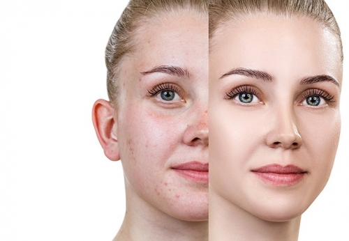 akne-sivilce-tedavisi-1513018439