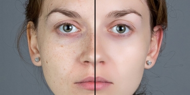 Endolift Lazer Ağı Teknolojisi Nedir?