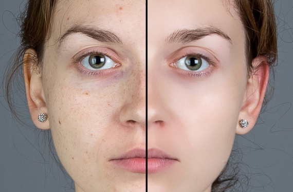 Endolift Lazer Ağı Teknolojisi Nedir?