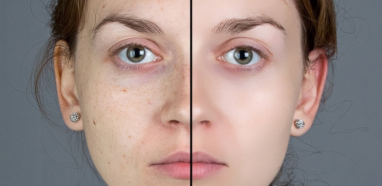 Endolift Lazer Ağı Teknolojisi Nedir?