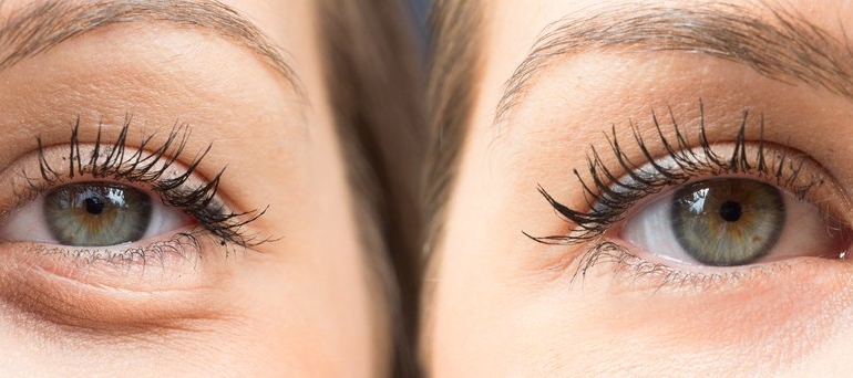 Gözaltı Torbaları İçin Ev Yapımı Serum
