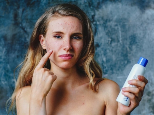 Geçmeyen Sivilcelerin Nedeni Psikolojik Olabilir