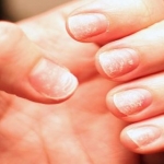 Demir Eksikliği ve Kansızlığın Belirtileri Neler?