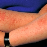 arm, polymorphic light eruption