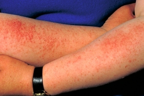 arm, polymorphic light eruption