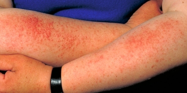 arm, polymorphic light eruption
