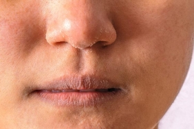 Kuru ciltlerin çilesi bitiyor! Bu ev yapımı maske önerileri sayesinde...