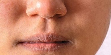 Kuru ciltlerin çilesi bitiyor! Bu ev yapımı maske önerileri sayesinde...