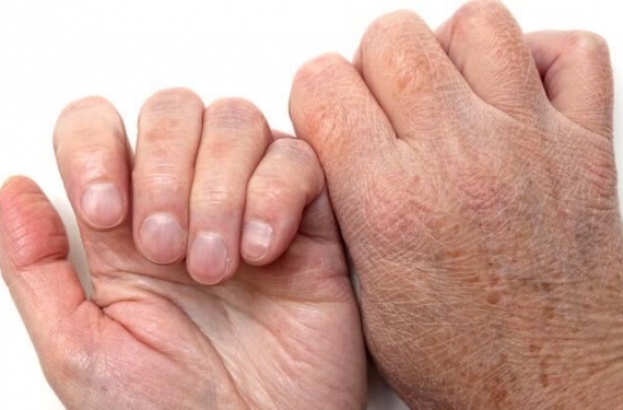 Tırnaklarda Beyaz Leke Neden Olur, Nasıl Geçer?