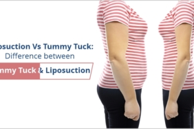 difference-between-tummy-tuck-and-liposuction.jpg