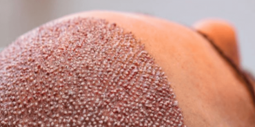 sac-ekimi-bilinmeyenler