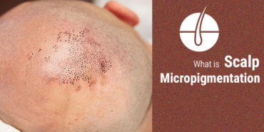 scalp-micropigmentation.png
