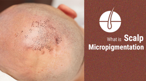 scalp-micropigmentation.png