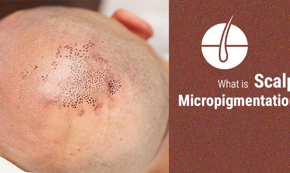 scalp-micropigmentation.png