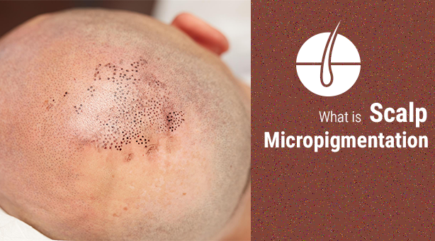 scalp-micropigmentation.png